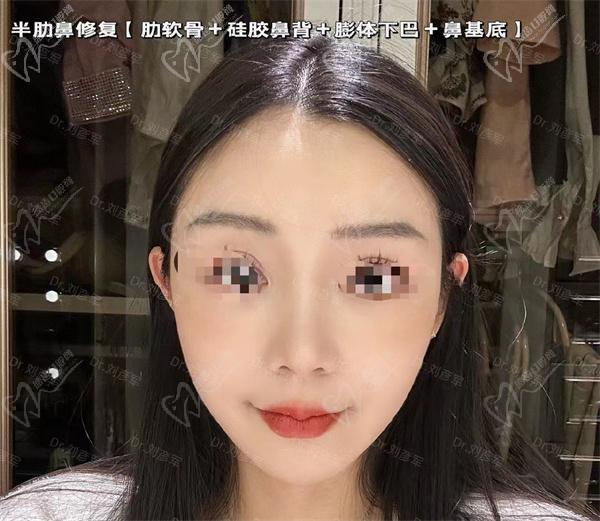 刘彦军鼻修复价格