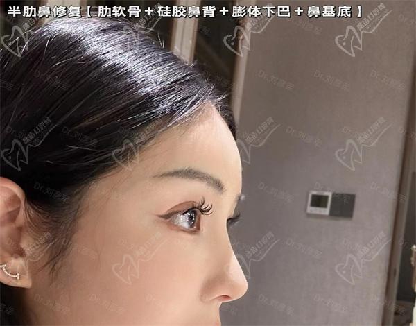 刘彦军鼻修复价格