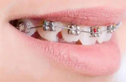 金属托槽矫正牙齿需要多久