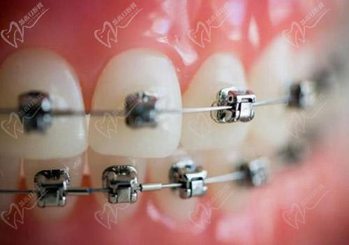 金属托槽矫正牙齿原理