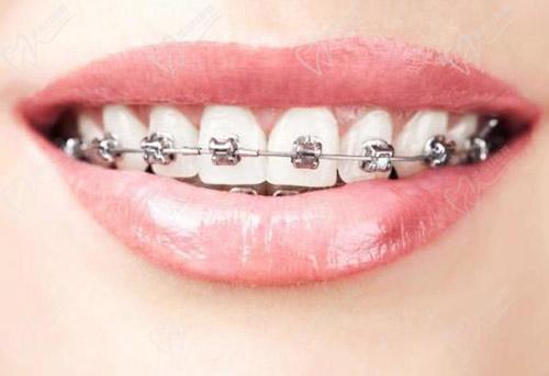 金属托槽矫正牙齿优势