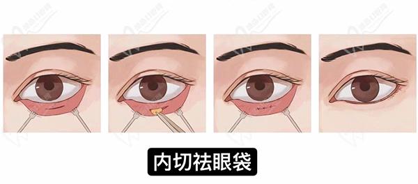 李艳双眼皮修复范例口碑好
