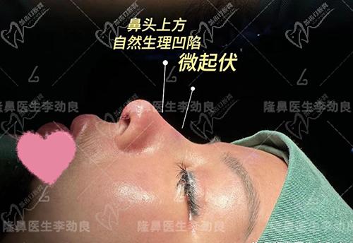北京李劲良做鼻子图片