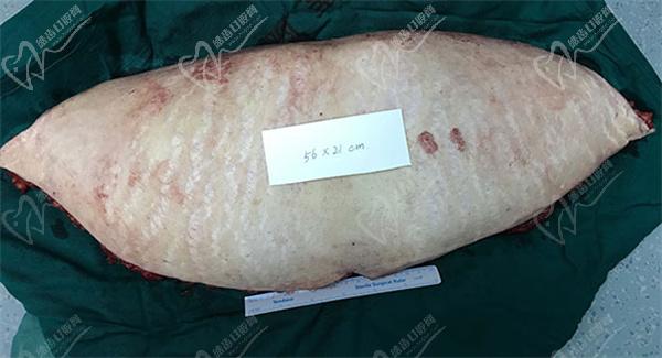 腹壁成形和腰腹环吸的区别是什么？