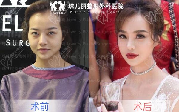 韩国珠儿丽整形真人手术前后对比图