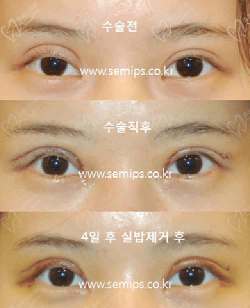 韩国世美双眼皮修复范例