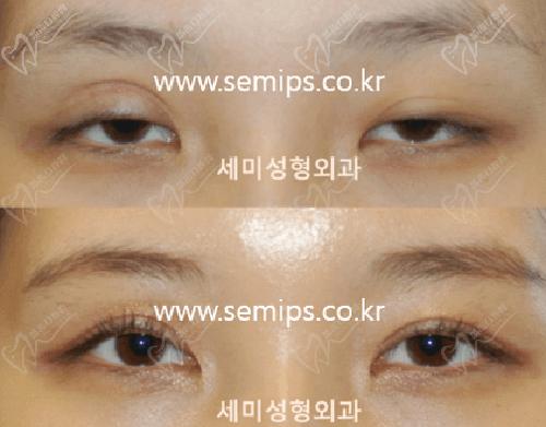 韩国世美整形植皮修复单或双眼皮范例
