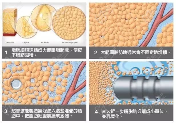 吸脂手术原理