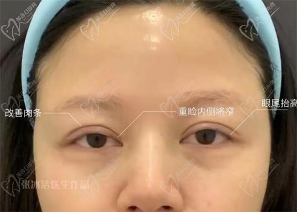 北京张冰洁修复双眼皮