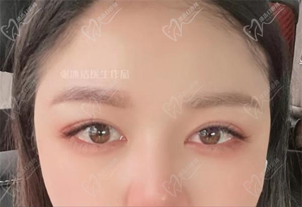 北京张冰洁修复双眼皮
