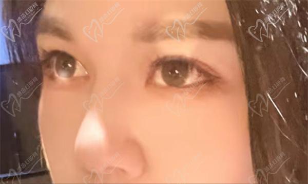 北京张冰洁修复双眼皮