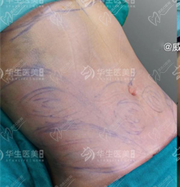 成都华生铂悦威塑吸脂