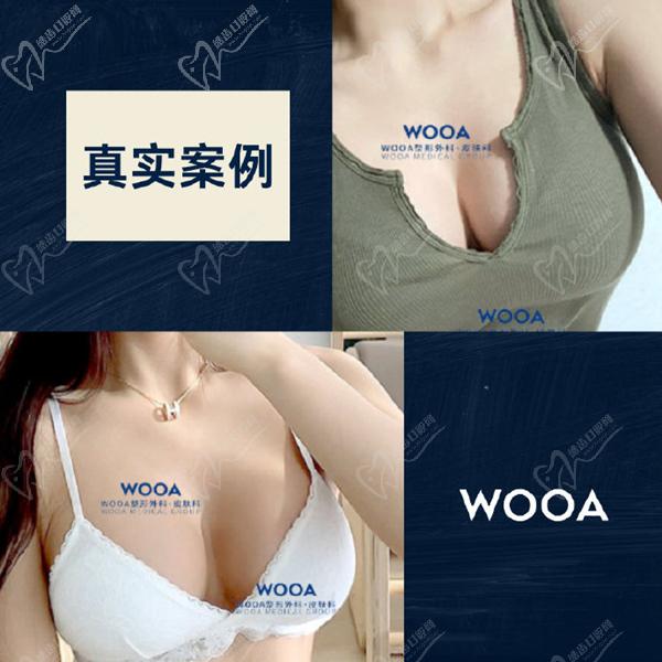 韩国WOOA整形外科医院隆胸图片