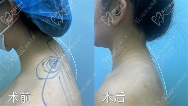 温州艺星徐淑卿一针除富贵包