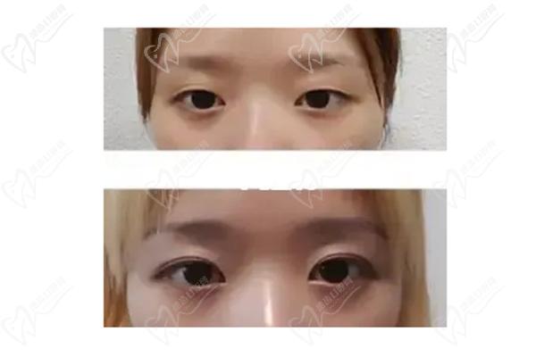 韩国大眼睛整形外科病例