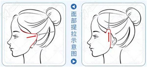 拉皮除皱
