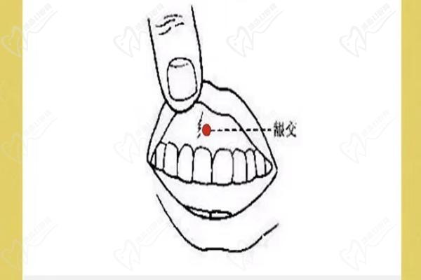 深圳福雅胡俊杰医生人中缩短术的优势