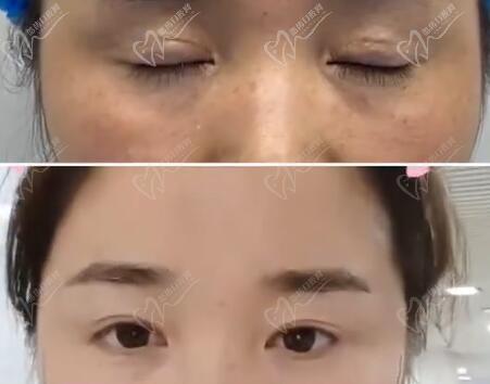 成都林靖医生修复眼睛怎么样 成都林靖医生修复眼睛怎么样