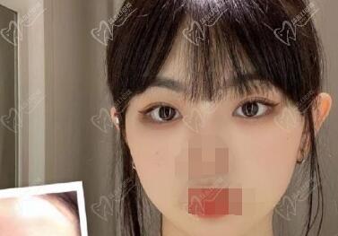 成都林靖修复后的眼睛自然吗 成都林靖修复后的眼睛自然吗