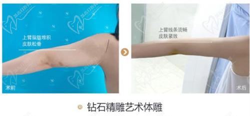 青岛华颜美张庆吸脂怎么样