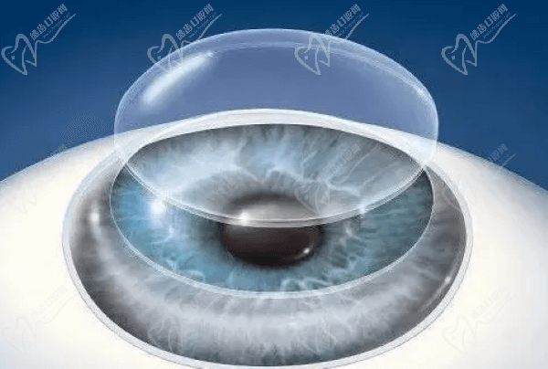 郑州爱尔眼科医院角膜移植的优势