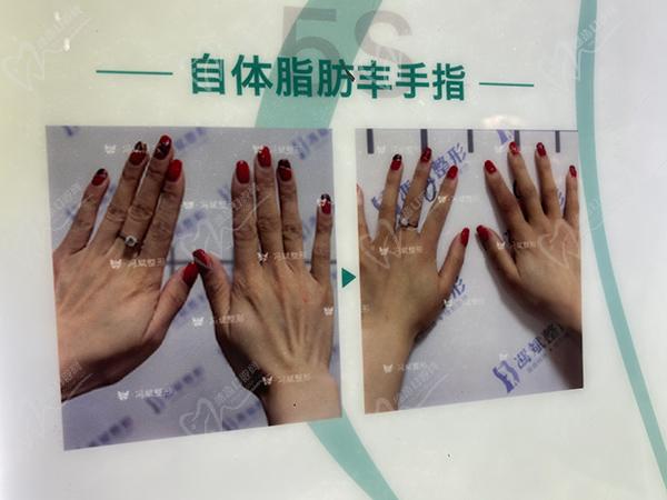 冯斌吸脂瘦身价格