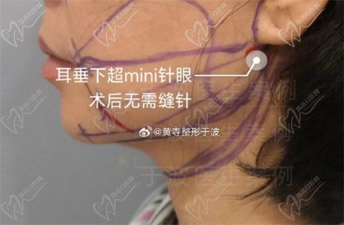 北京黄寺于波吸脂怎么样