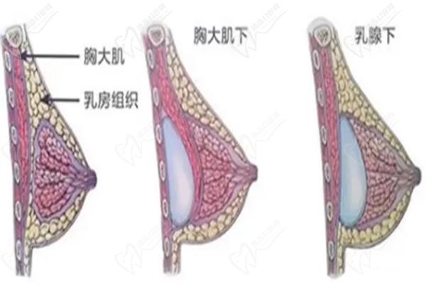 栾杰医生隆胸的手术收费