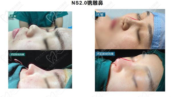 成都东篱NS2.0镌雕鼻技术