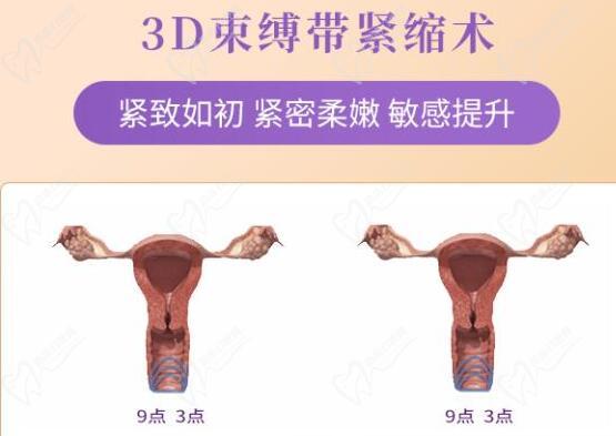 3d生物束带紧缩术和传统的有什么不一样