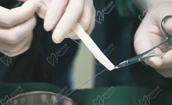 3D生物束带紧缩术一般用几根?