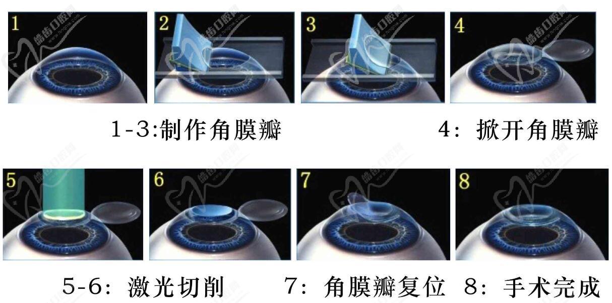 激光角膜屈光手术流程图