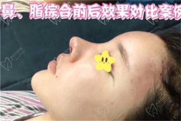 泰国曼谷雨整形医院病例