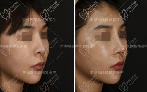 谁找李保锴做鼻修复对比
