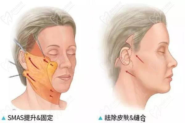 哈尔滨名大医疗美容医院除皱