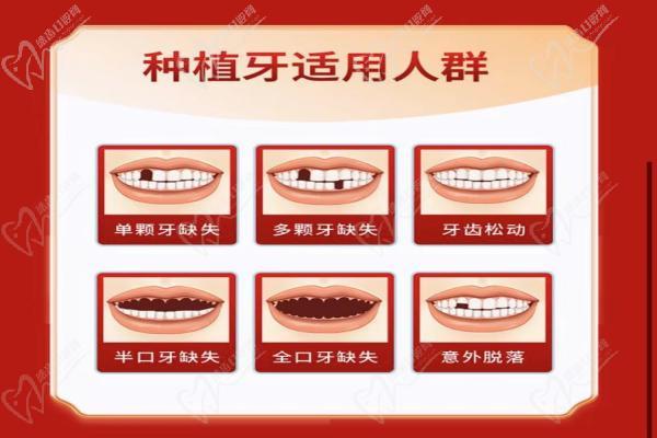 种植牙适用人群