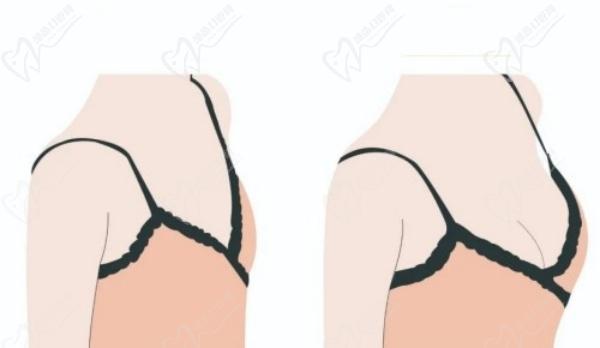 上海美莱汪灏隆胸怎么样