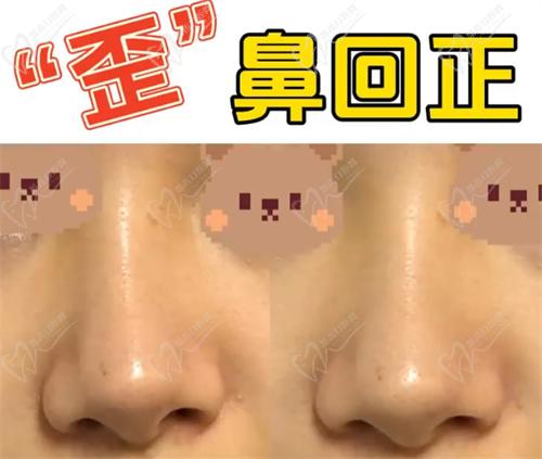 八大处歪鼻矫正案 例
