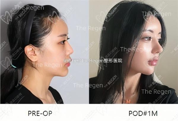 韩国德丽珍金虎吉院长为小姐姐设计的鼻综合手术
