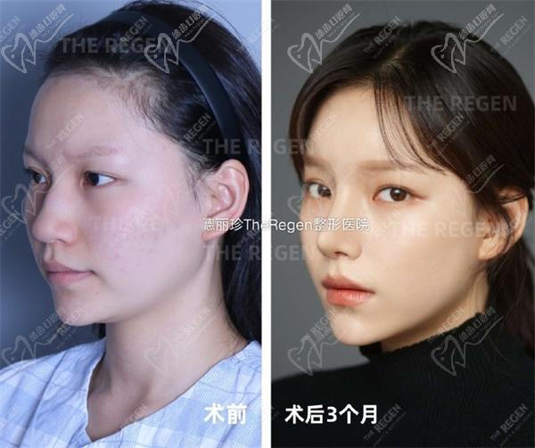 韩国德丽珍鼻综合+轮廓三件套