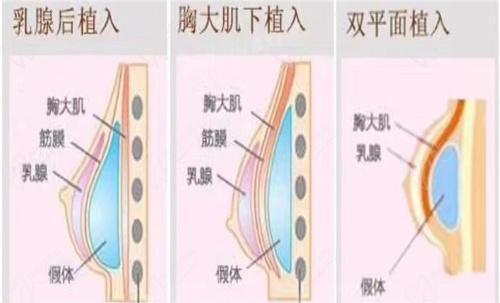 窦玺隆胸手术怎么样