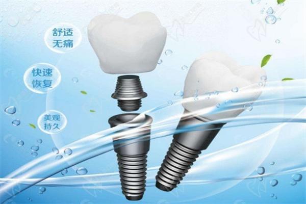日照微笑口腔种植牙怎么样
