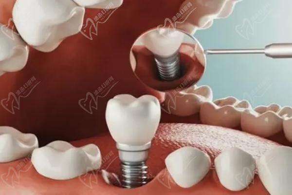 日照微笑口腔种植牙怎么样