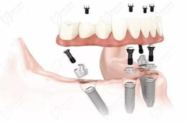 日照微笑口腔种植牙