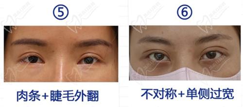 丽星翼美可以做内眼角修复吗