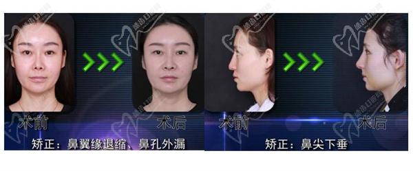 北京沃尔鼻整形图片
