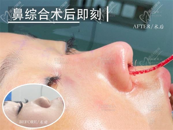 郑州臻颜池凯隆鼻手术图片