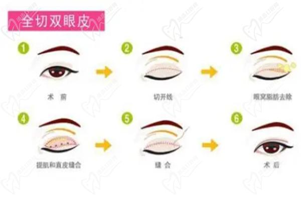 四川省人民医院蔡震做双眼皮怎么样