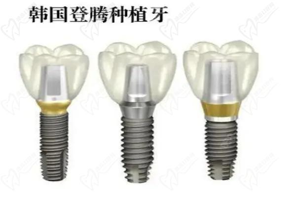 登腾种植牙示意图