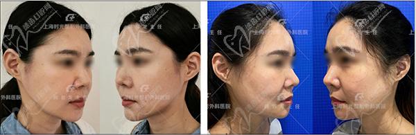 上海何晋龙磨骨案 例分享